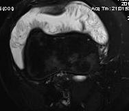 Lipoma Arborescens MRI Axial